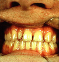 Hypodontia 2.2 and Peg lateral.jpg